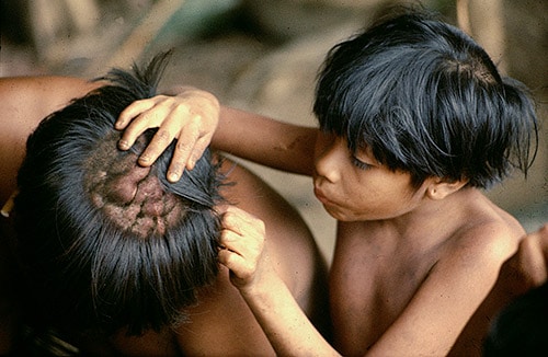 Club fight scars on a Yanomamo man. Figure from Chagnon.